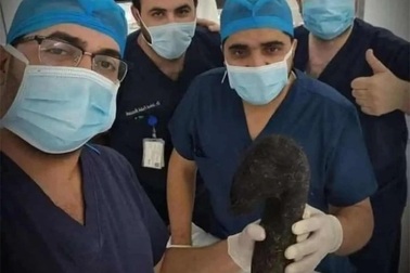 Bác sĩ lấy búi tóc nặng 6 kg ra khỏi bụng cô gái trẻ