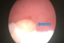 Cậu bé 10 tháng tuổi tắc tiểu vì sỏi thận