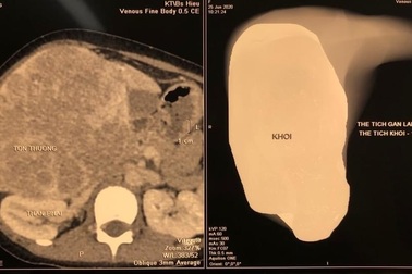 Trẻ mới 12 tuổi đã mắc ung thư gan, cha mẹ cần cảnh giác