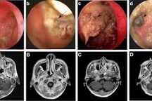 Yếu tố nào dẫn đến ung thư vòm họng?