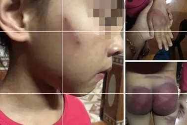 Công an vào cuộc vụ cháu bé bị bố đẻ hành hung