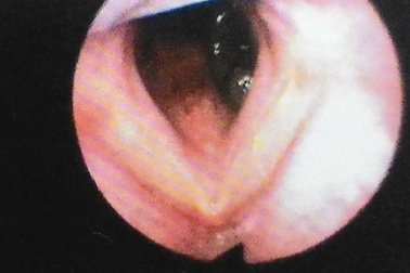 Ho ra máu vì đỉa suối cư ngụ trong cuống họng