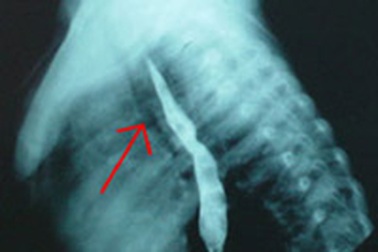 Lần đầu phẫu thuật tạo hình khí quản