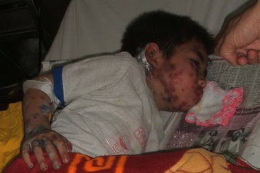 Bé trai dị ứng, tổn thương toàn thân vì phấn trang điểm