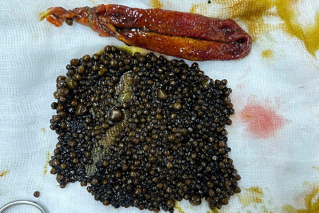 Cụ bà ở miền Tây sống với túi mật chứa 1.100 viên sỏi suốt 3 năm - 1 Cụ bà ở miền Tây sống với túi mật chứa 1.100 viên sỏi suốt 3 năm - 1