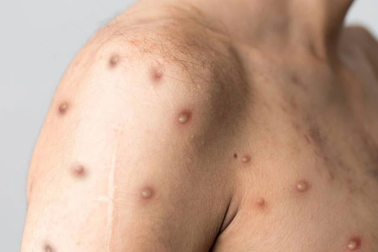 Kiên Giang ghi nhận 3 trường hợp mắc bệnh đậu mùa khỉ