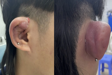 Hà Nội: Nhiều Gen Z tai đầy mủ, biến dạng vì bấm 4-5 lỗ tai