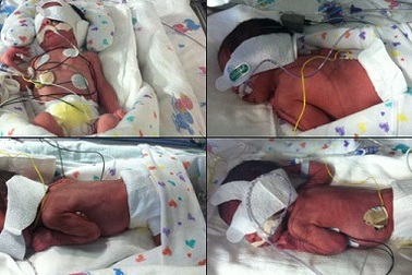 Hy hữu ca đẻ hai cặp sinh đôi cùng lúc