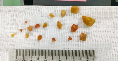 3 trẻ hóc hạt lạc, suy hô hấp nặng