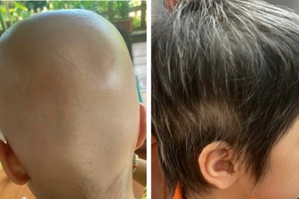 Nhiều người trẻ bỗng dưng rụng tóc trơ trọi