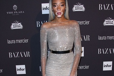 Người mẫu bạch tạng vẫn nổi tiếng