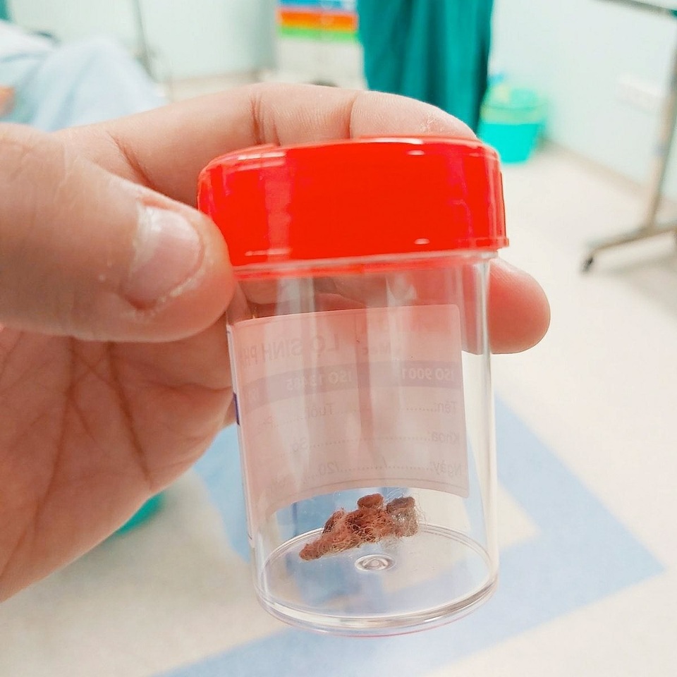 Âm đạo bé gái trào mủ vì mảnh bông gòn - 2 Âm đạo bé gái trào mủ vì mảnh bông gòn - 2
