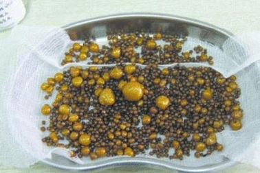 Nguyên nhân chính hình thành các loại sỏi đường tiết niệu