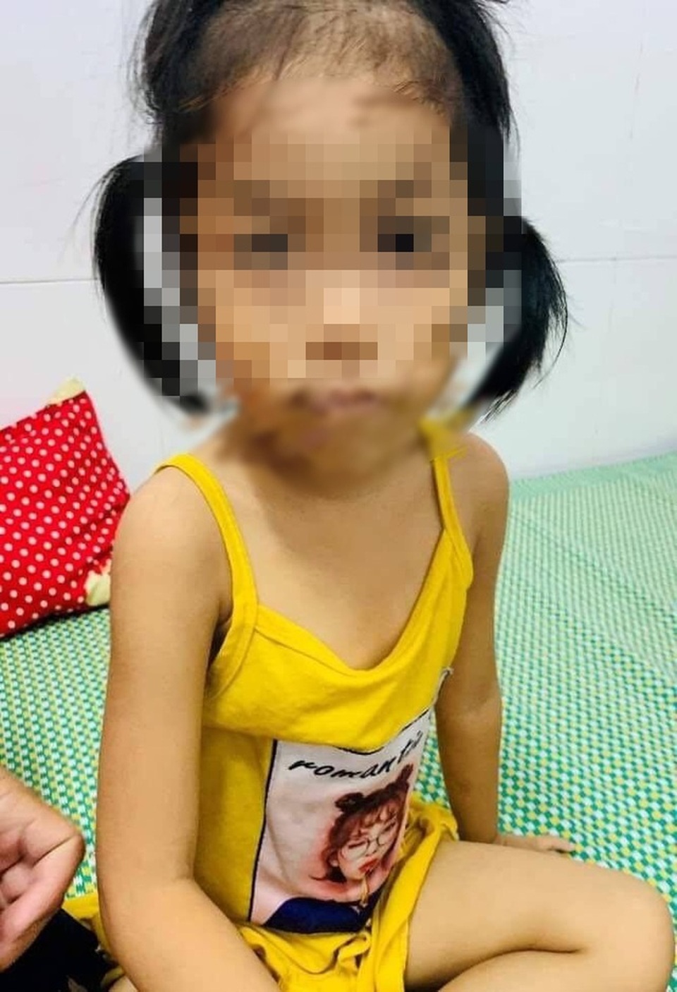 Bé gái 4 tuổi suýt mất mạng vì ăn canh lá lộc mại chữa táo bón - 1 Bé gái 4 tuổi suýt mất mạng vì ăn canh lá lộc mại chữa táo bón - 1