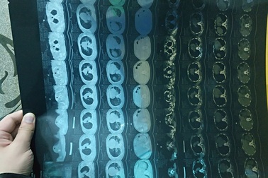 Báo cáo mới về 138 ca nhiễm nCoV-2019 cho thấy nhiều điều đáng lo ngại