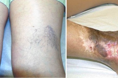 Suy tĩnh mạch chân – đừng để nhẹ thành nặng