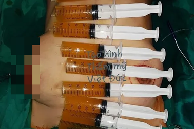Bác sĩ “tháo ngòi” quả “bom ngực” như sắp nổ
