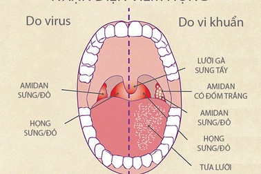 Chuyên gia chỉ cách nhận diện viêm họng nào cần dùng kháng sinh
