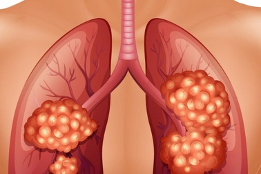 Ung thư phổi khó phát hiện sớm, điều gì làm tăng nguy cơ mắc bệnh?