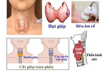 Ung thư tuyến giáp: Thường gặp nhưng dễ trị