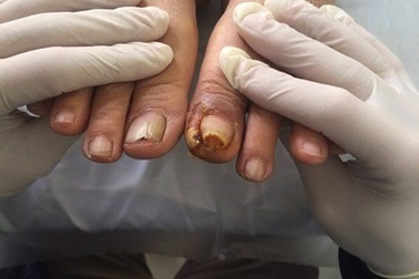 Cứ 30 giây lại có một người bị cắt cụt chân vì đái tháo đường