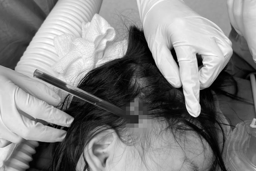 Chơi đùa vấp té, bé gái 4 tuổi bị cây bút bi đâm vào đầu nứt sọ nguy kịch - 1 Chơi đùa vấp té, bé gái 4 tuổi bị cây bút bi đâm vào đầu nứt sọ nguy kịch - 1