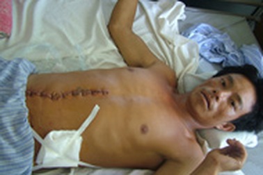 Một thanh niên bị đâm thủng nhiều khúc ruột