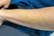 Quét dọn vườn trong resort ở Phú Quốc, nam thanh niên bị rắn độc cắn