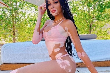 Winnie Harlow diện áo tắm bốc lửa