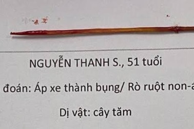 Người đàn ông bị tăm xỉa răng đâm thủng ruột, đâm xuyên thành bụng