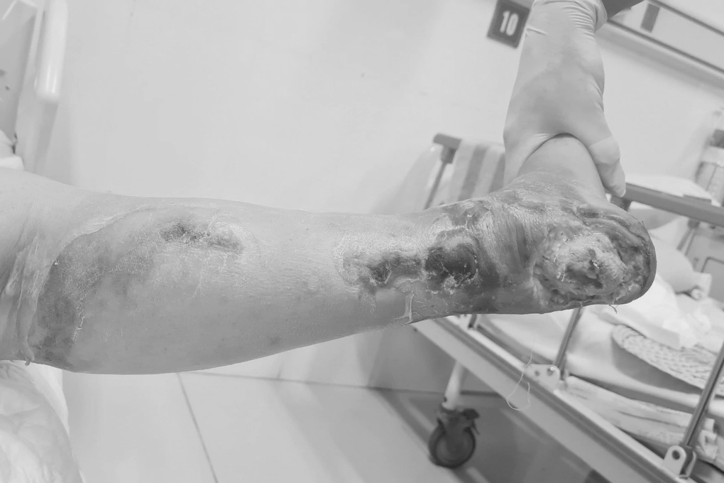 Nữ bệnh nhân phải cắt cụt chi vì biến chứng đái tháo đường - 1 Nữ bệnh nhân phải cắt cụt chi vì biến chứng đái tháo đường - 1