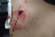 Nam học sinh bị đánh phải nhập viện với nhiều vết thương