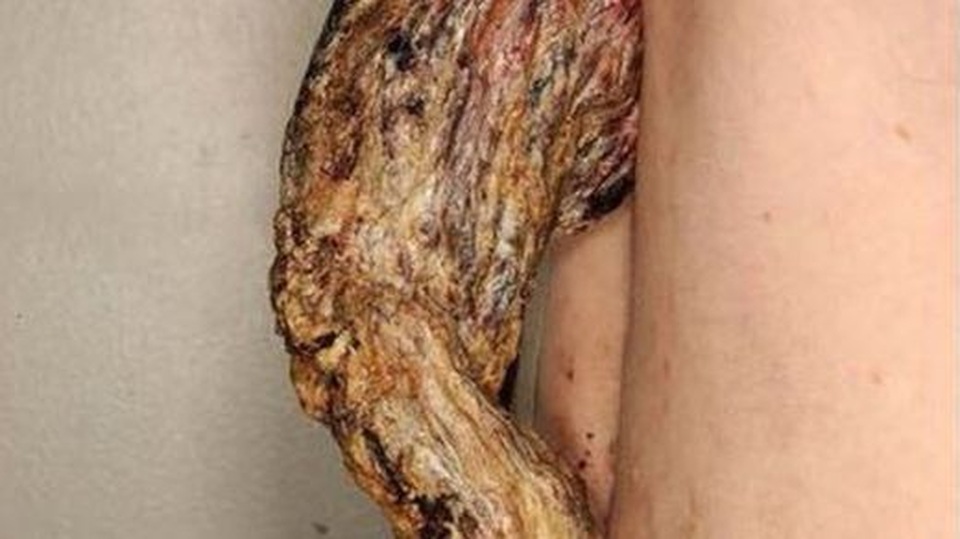 Người đàn ông “mọc sừng” dài 14 cm trên lưng vì…ung thư da - 1 Người đàn ông “mọc sừng” dài 14 cm trên lưng vì…ung thư da - 1