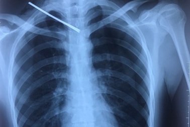 Cứu sống nam thanh niên bị cây sắt đâm xuyên phổi