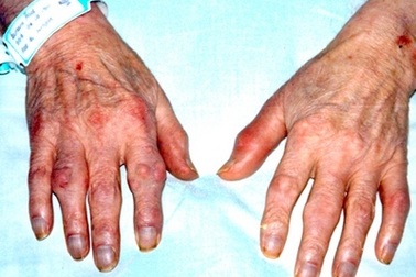 Biến chứng nguy hiểm của bệnh tiểu đường