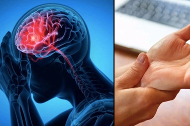 Dấu hiệu nào cảnh báo đột quỵ sắp xảy ra?