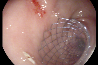 Căn bệnh khiến người phụ nữ lâm nguy vì "cứ ăn là nôn", không thể đại tiện