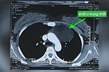 Đau sau lưng, phát hiện khối u trung thất lớn