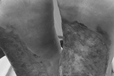 Suýt mất chân vì “đèn sưởi đá muối” chữa tê bì, nhức mỏi tay chân