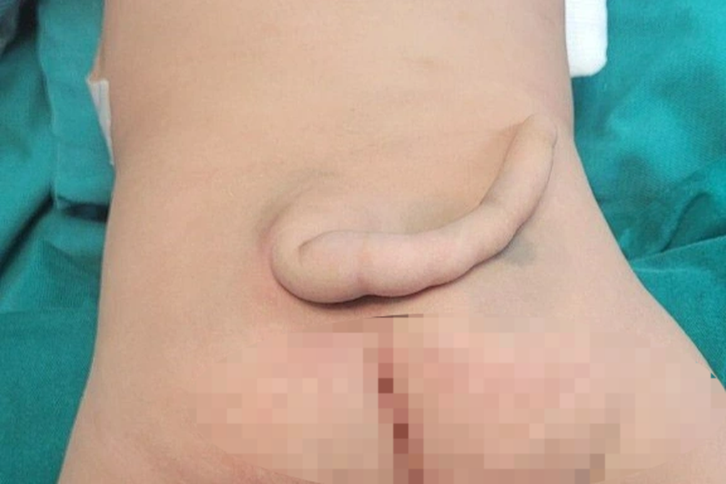 Bé trai 4 tháng tuổi có đuôi dài 14cm - 1