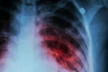 Bước tiến lớn trong tìm ra vắc xin bệnh lao