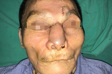 "Vá" ổ loét lớn mũi, má cho bệnh nhân ung thư da kích thước lớn