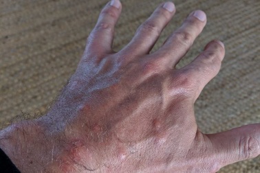 Mua vé máy bay hạng sang hơn 100 triệu đồng, hành khách khổ sở vì rệp cắn