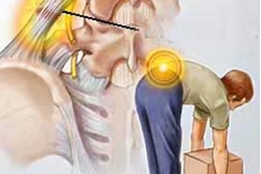 Thoát vị đĩa đệm có phải là bệnh?