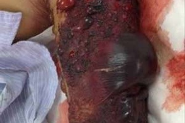 Truyền gần 46 lít máu cứu bệnh nhân bị rắn lục cắn