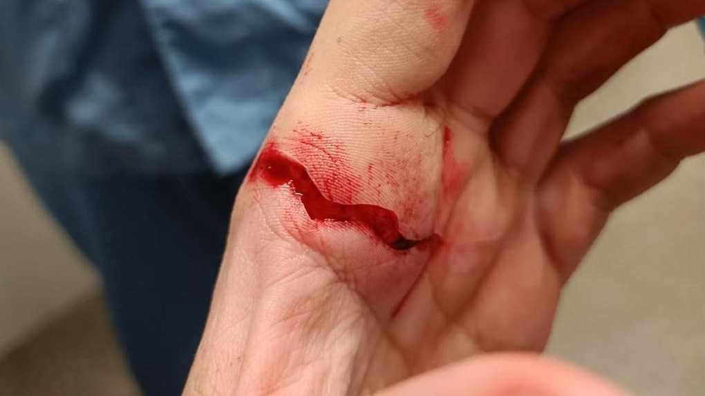 Huấn luyện viên ở Tây Ban Nha bị nhóm CĐV chém suýt đứt bàn tay - 1 Huấn luyện viên ở Tây Ban Nha bị nhóm CĐV chém suýt đứt bàn tay - 1