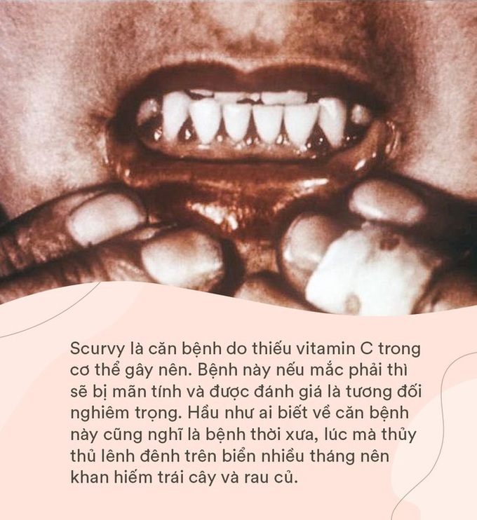 Sự thật bí ẩn phía sau “lời nguyền” đã giết chết hàng triệu thủy thủ và đoàn thám hiểm ngày xưa, giờ mới được khoa học hé lộ bằng y học - Ảnh 5.