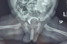 Ca mổ "lần đầu tiên" tại bệnh viện ở TPHCM cứu cháu bé 1 tháng tuổi