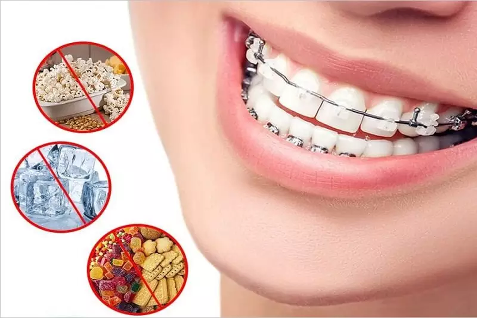 Nha khoa Răng Xinh thành phố Vinh tư vấn kỹ năng chăm sóc sau niềng hiệu quả - 3 Nha khoa Răng Xinh thành phố Vinh tư vấn kỹ năng chăm sóc sau niềng hiệu quả - 3
