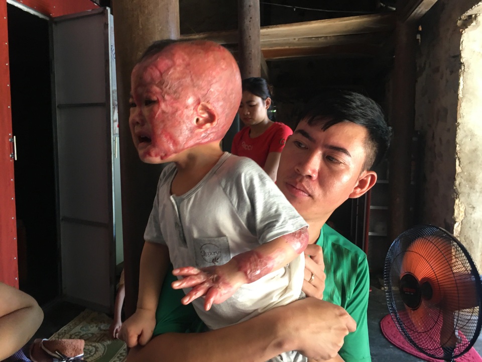 Đau nhói lòng cảnh cậu bé 2 tuổi bị bỏng xăng nặng do chơi trò sinh nhật - 1 Đau nhói lòng cảnh cậu bé 2 tuổi bị bỏng xăng nặng do chơi trò sinh nhật - 1